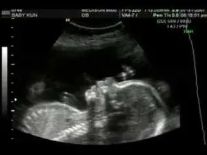 22 Weeks Pregnant ultrasound