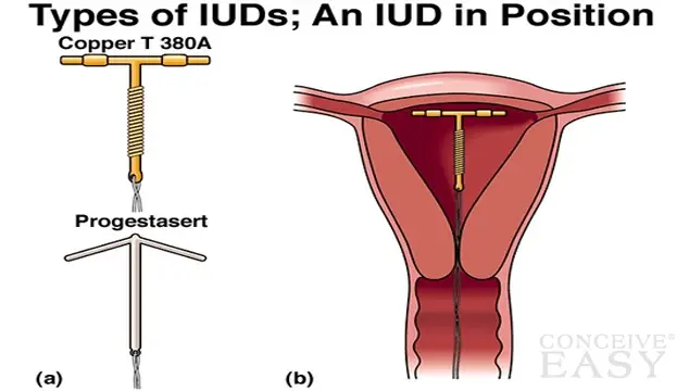 Can You Get Pregnant On The IUD