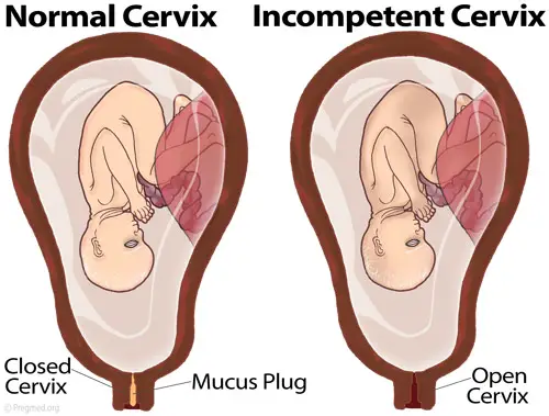 What Causes Incompetent Cervix