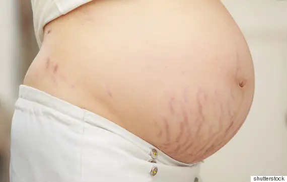 Stretch Marks While Pregnant