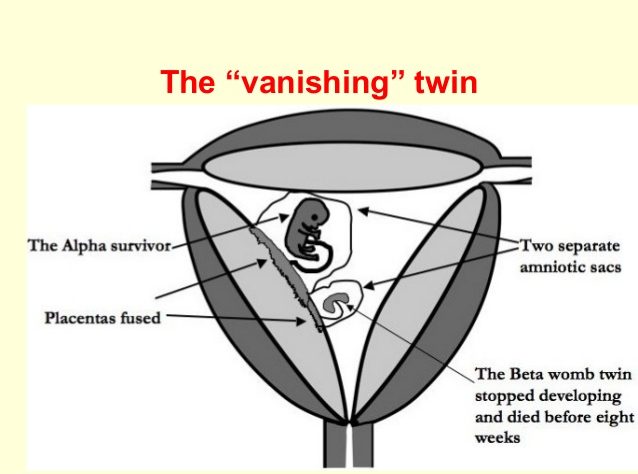 Vanishing Twin Syndrome