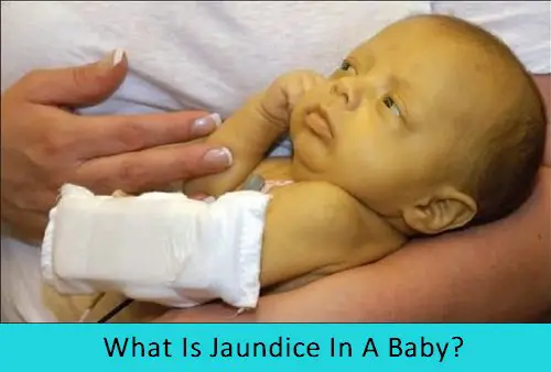 What Is Jaundice And How Is It Treated