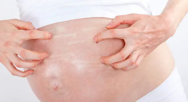 What Are The Symptoms Of Cholestasis Of Pregnancy