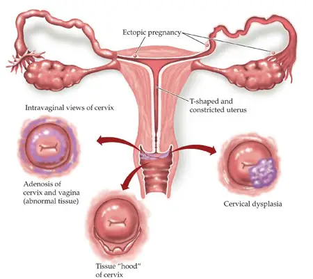 What Is A Cervical Cerclage