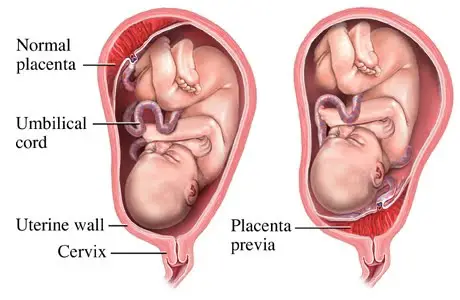 Placental Medical Conditions