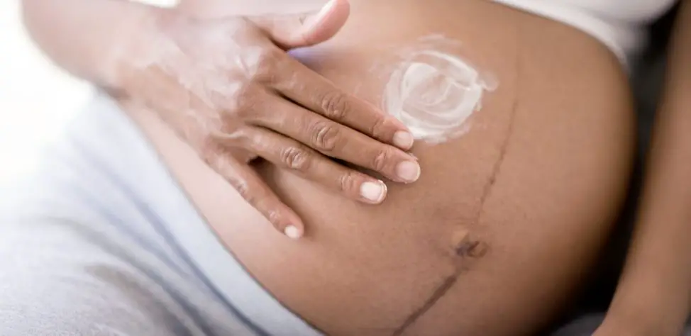 How to Get Rid of Linea Nigra after Giving Birth