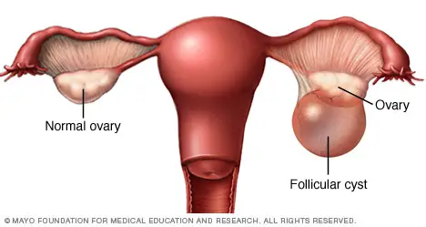 What Is An Ovarian Cyst