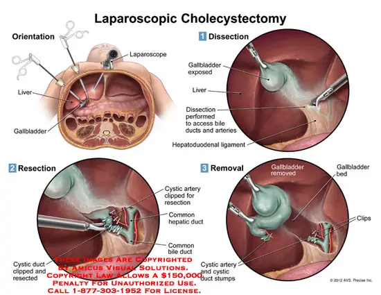 What Is Laparoscopic Cholecystectomy