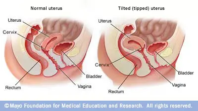 Retroverted Uterus During Pregnancy