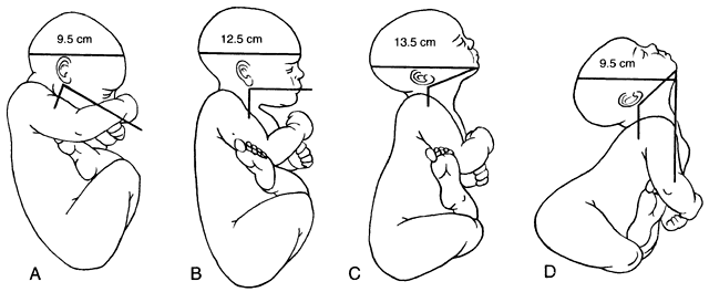 Abnormal Fetal Positions