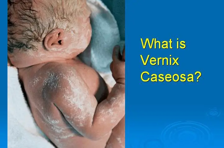 What Is Vernix Caseosa