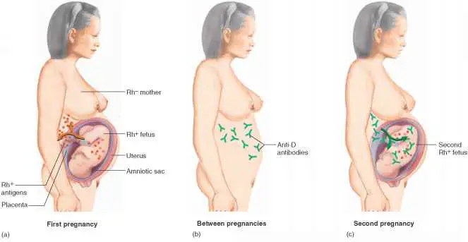What Is Hemolytic Disease Of The Newborn