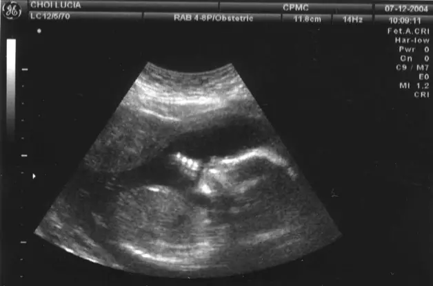 How Can You Tell If It’s A Girl Or Boy On Ultrasound