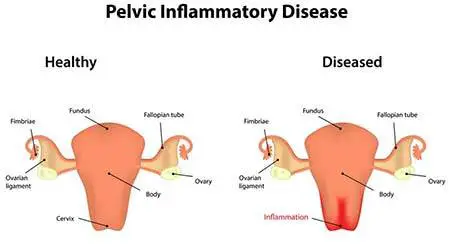 How Long Does It Take To Heal Pelvic Inflammatory Disease